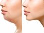 How To Get Rid Of Double Chin Fast At Home